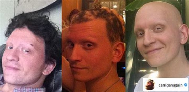 Anthony Carrigan With Hair Photos & Alopecia Condition, Fans Think Actor Might Be Battling Hair Loss