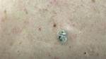 Dr Pimple Popper: Pore of Winer Extraction Explored What Is Tlc Shows Biggest Blackhead?