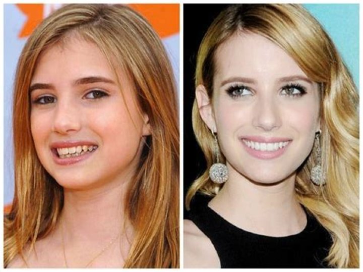 Emma Roberts Plastic Surgery Before and After