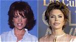 Lisa Rinna's Plastic Surgery Explained |