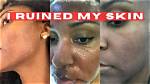Microneedling Ruined My Skin: a Cautionary Tale