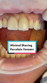 Teeth Shaving for Veneers: Why Tiktok's Shark Teeth Procedure Is Wrong and Dangerous, Accordin