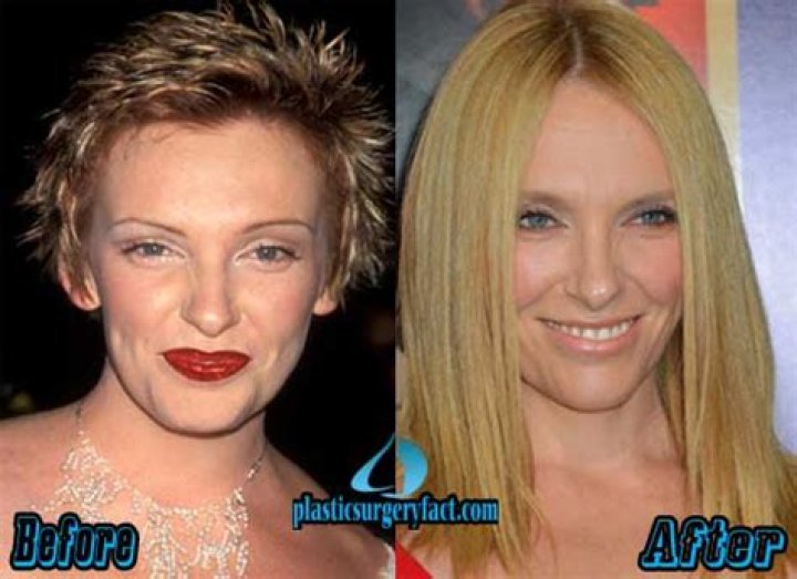 Toni Collette Plastic Surgery Before and After
