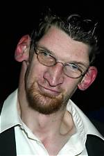 Understanding Matthew Mcgrory's Disease: a Deep Dive into Acromegaly