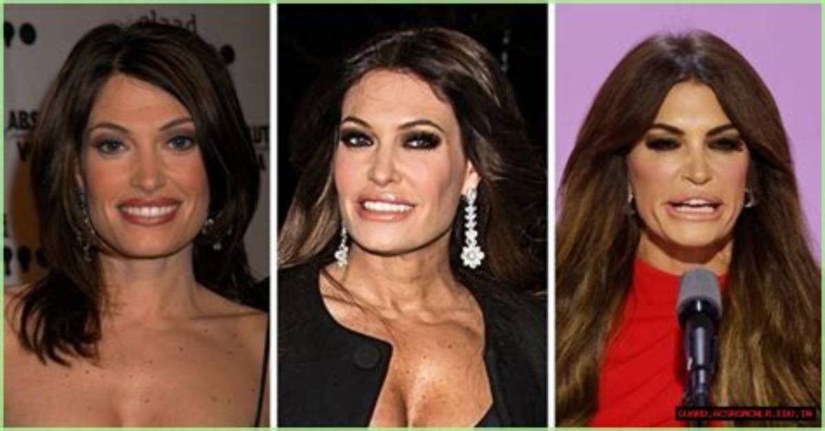 Unveiling the Transformation: Kimberly Guilfoyle's Facelift Journey